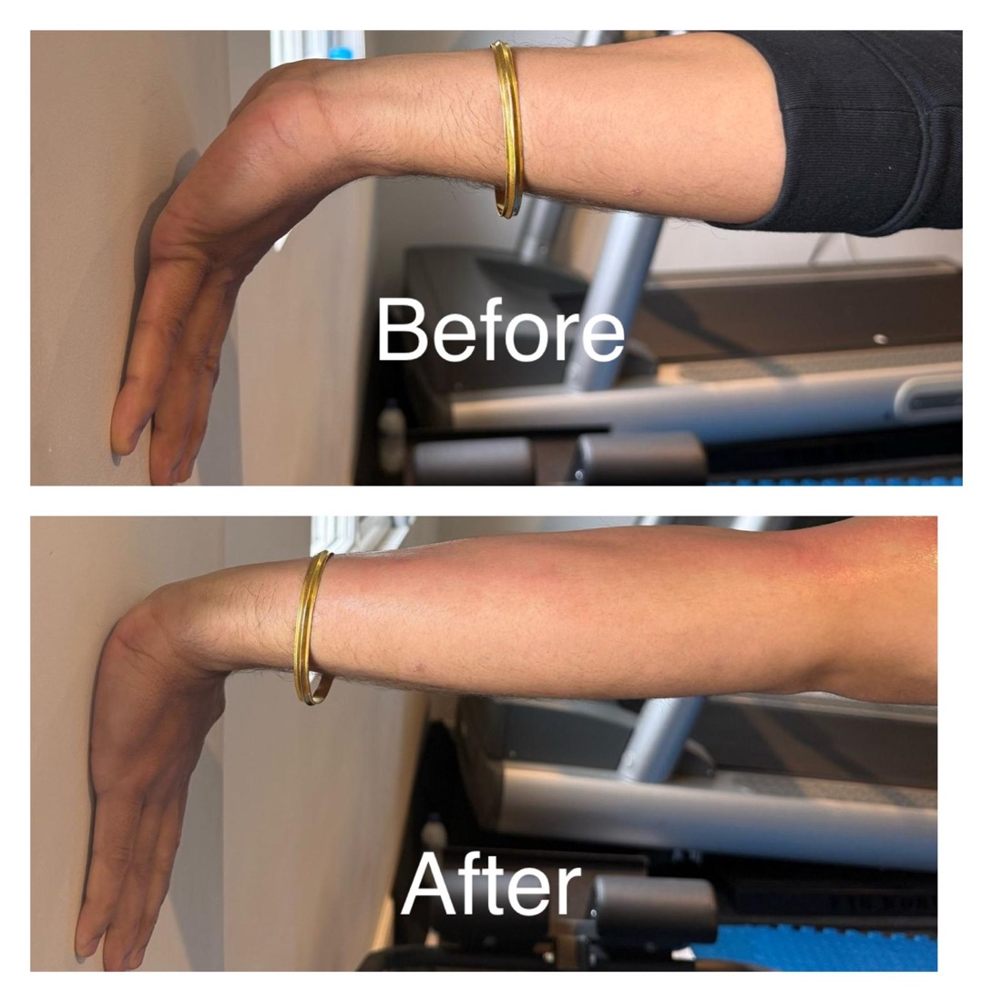 Client's forearm and wrist against a wall before and after treatment for tennis elbow, showing a much deeper wrist bend after treatment