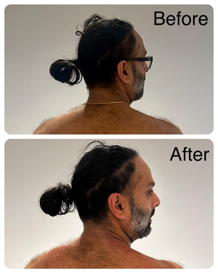 Client turning their head before and after neck treatment: before, the head only turns part-way; after, it turns to a full side profile